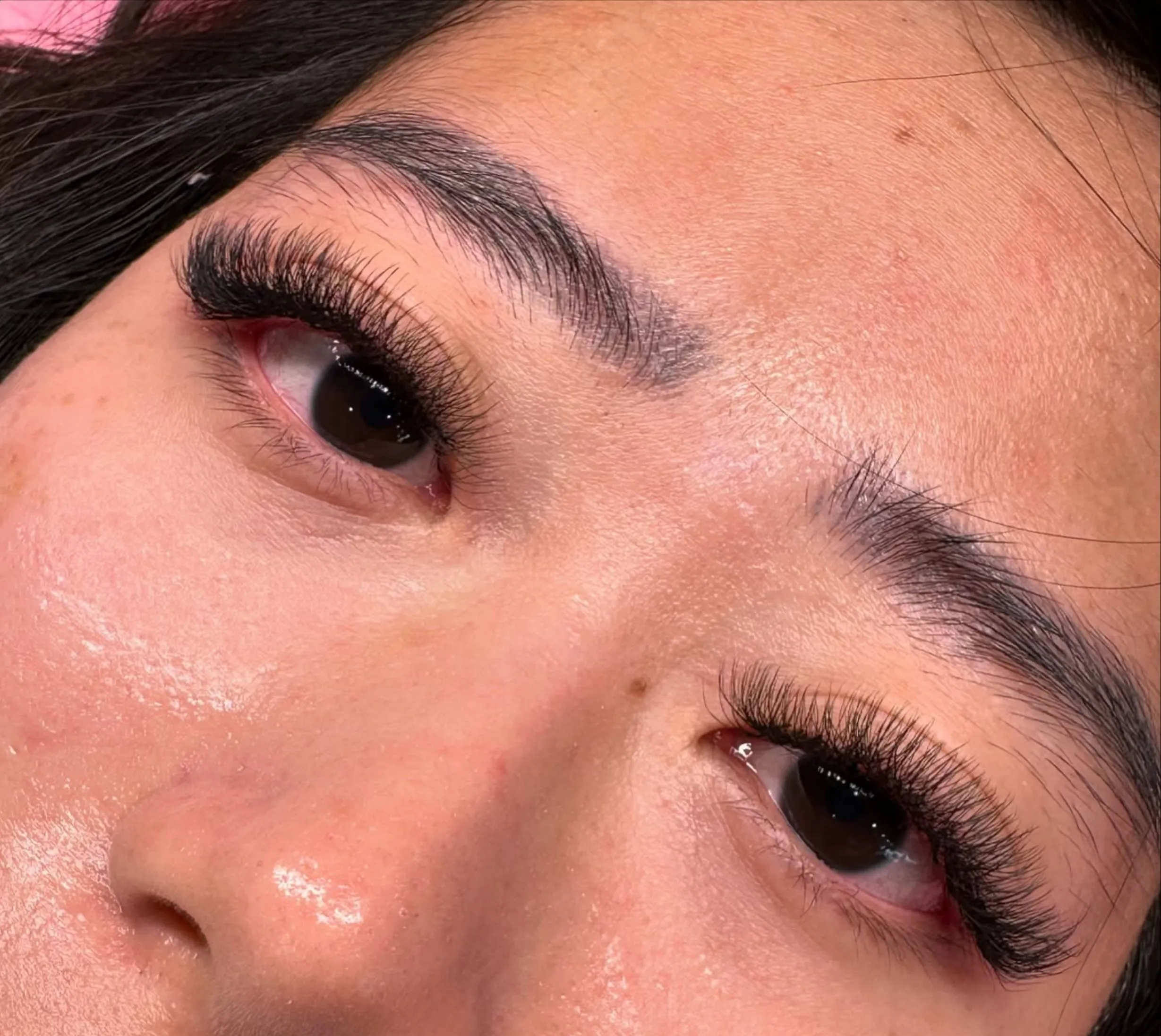 eyelash extension allergy