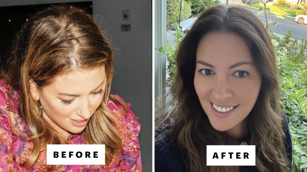 What About Brow Loss From Alopecia?