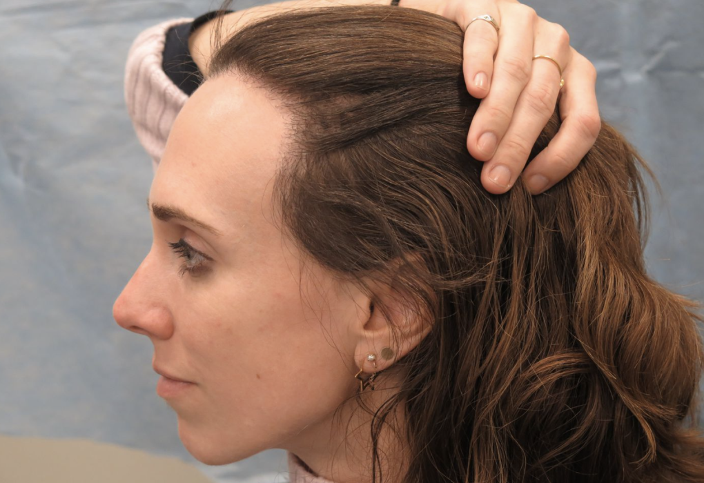 What’s The Best Solution For Thinning Hairlines And Alopecia?