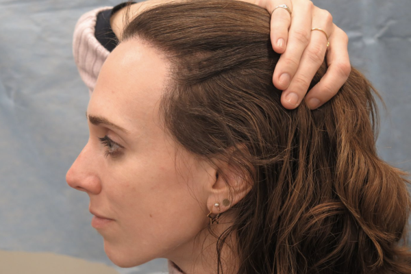 What’s The Best Solution For Thinning Hairlines And Alopecia?