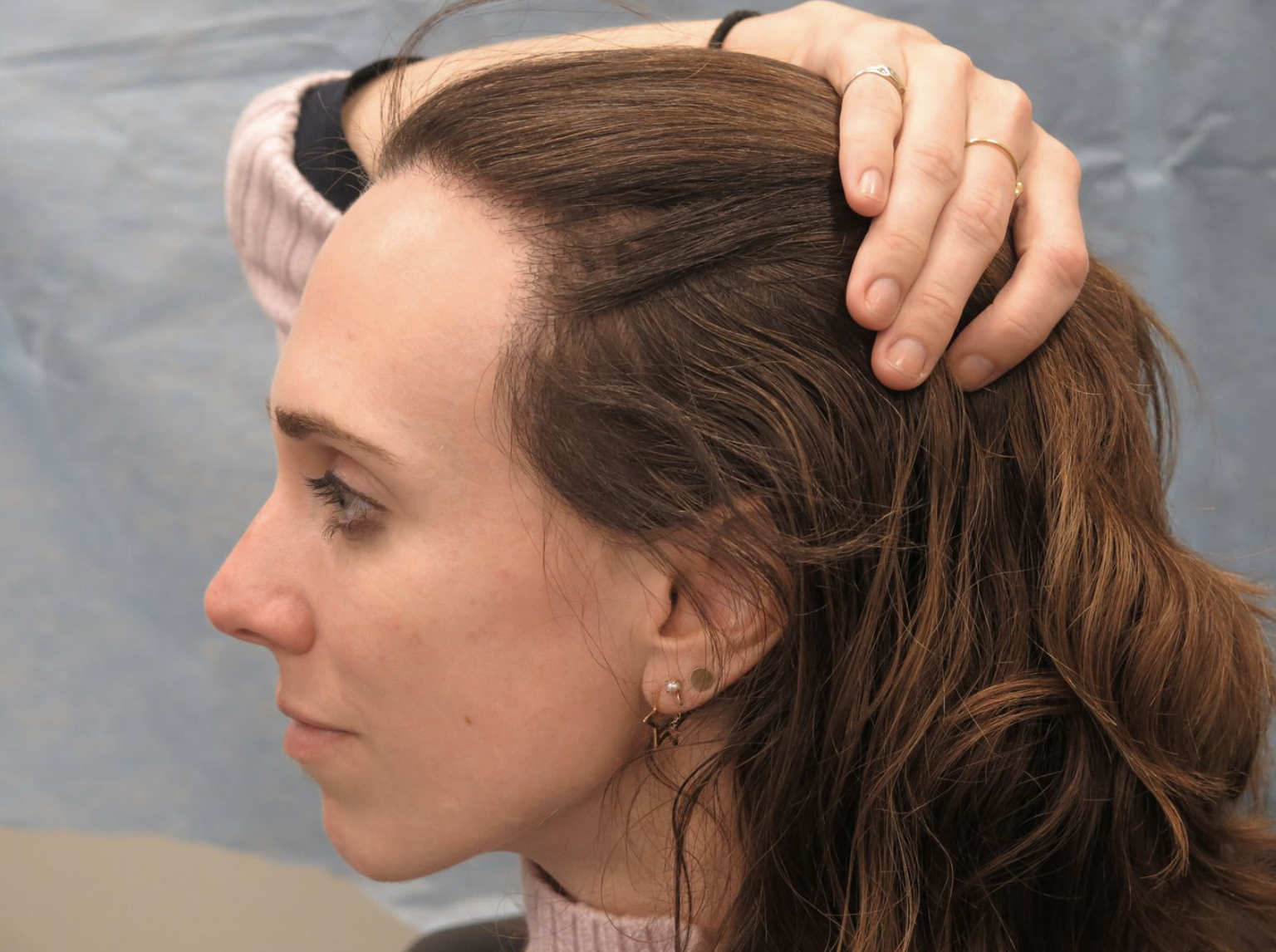 What’s The Best Solution For Thinning Hairlines And Alopecia?