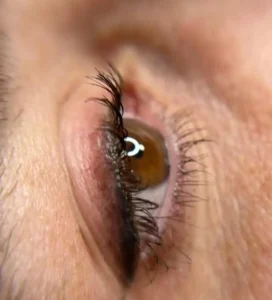 before and after eyelid tattoo