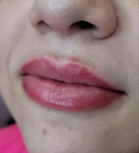 dark lip neutralisation before after brisbane
