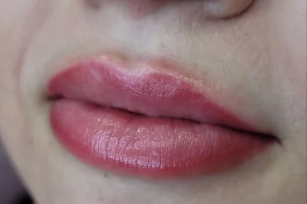 dark lip neutralisation before after brisbane
